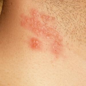 Wrestling Rashes wrestling injuries in sports medicine | AOSSM