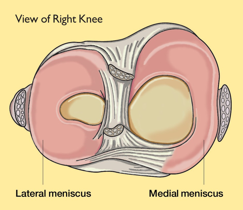 Meniscus Inner Rim Meniscal Tears in Athletes of all Ages | AOSSM
